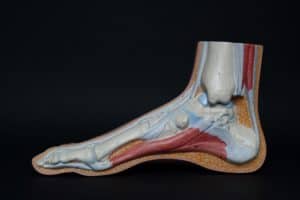 Achilles tendinitis