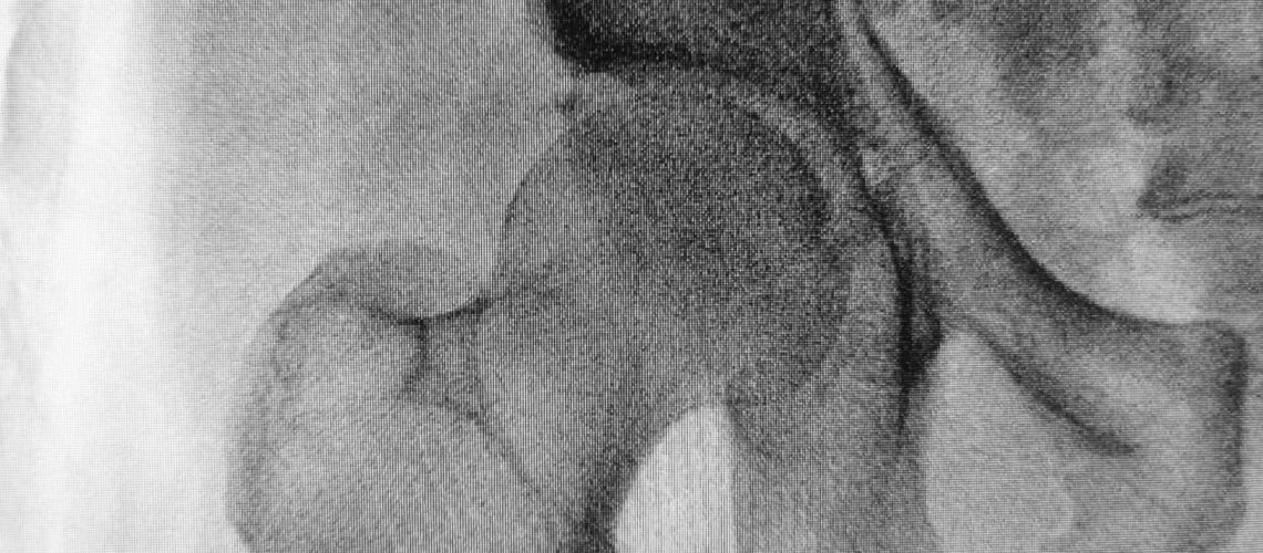 osteoarthritis of the hip