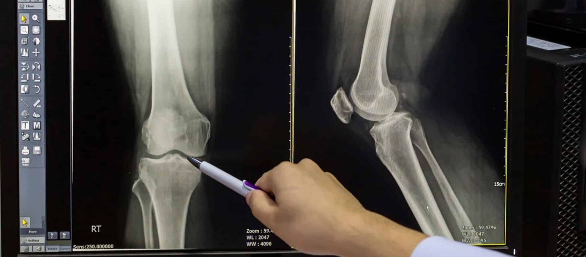 Total Knee Replacement (Arthroplasty): Everything You Need to Know